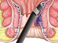 اعراض البواسير الداخلية بالصور
