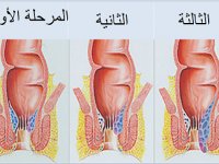 بالصور البواسير الداخلية ومراحلها وانواعها